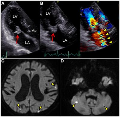 Miniature Erupting Volcano-Shaped Mitral Valve Aneurysm Secondary to Streptococcus agalactiae ST1656 Endocarditis: A Case Report